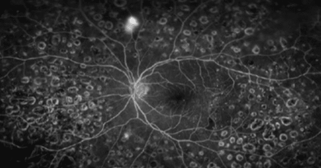 Neovascularization Detected by Fluorescein Angiography (FAG) img