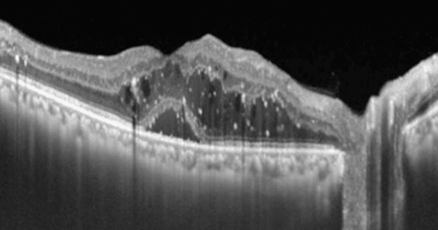 Diabetic Macular Edema (DME) Detected by Optical Coherence Tomography (OCT) img