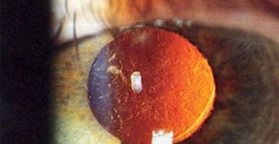 PCO after Cataract Surgery(Laser Capsulotomy / Source: Wikipedia)